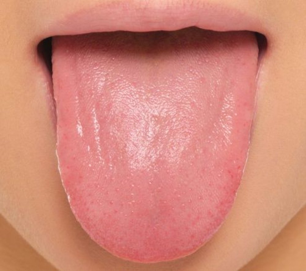 मुखमा खटिरा आएको छ ? अपनाउनुस् यस्तो उपाय